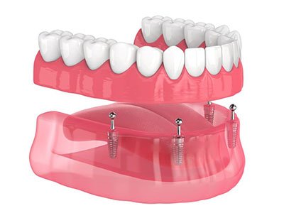 próteses dentarias fixas